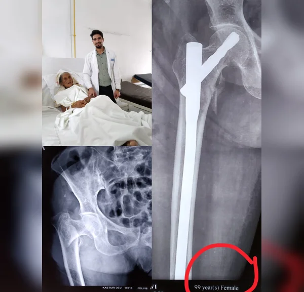 Successful Hip Fixation Surgery In 99 Year Old Patient