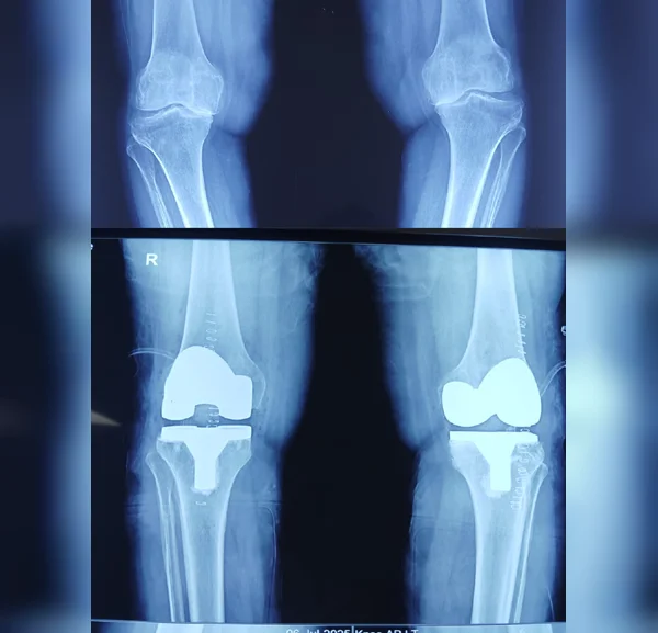 Total Knee Replacement