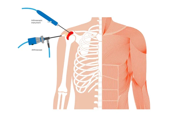 Shoulder Replacement Surgery