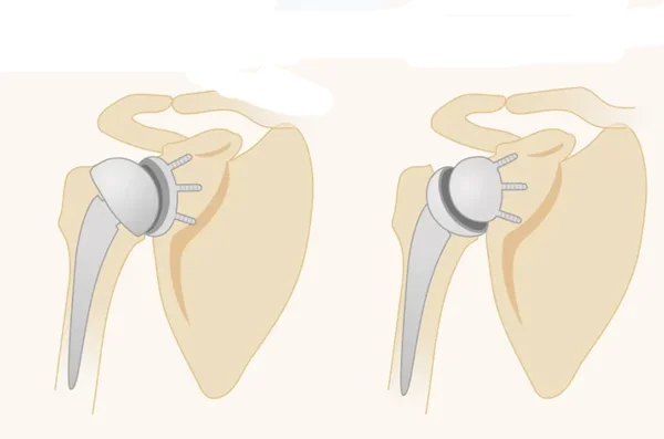 Reverse Shoulder Replacement Surgery