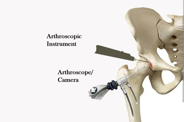 Hip Arthroscopy Surgery